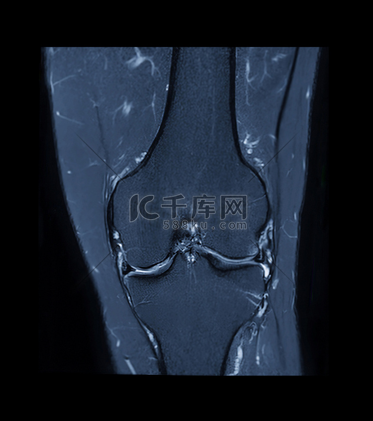 膝关节 MRI 或膝关节磁共振