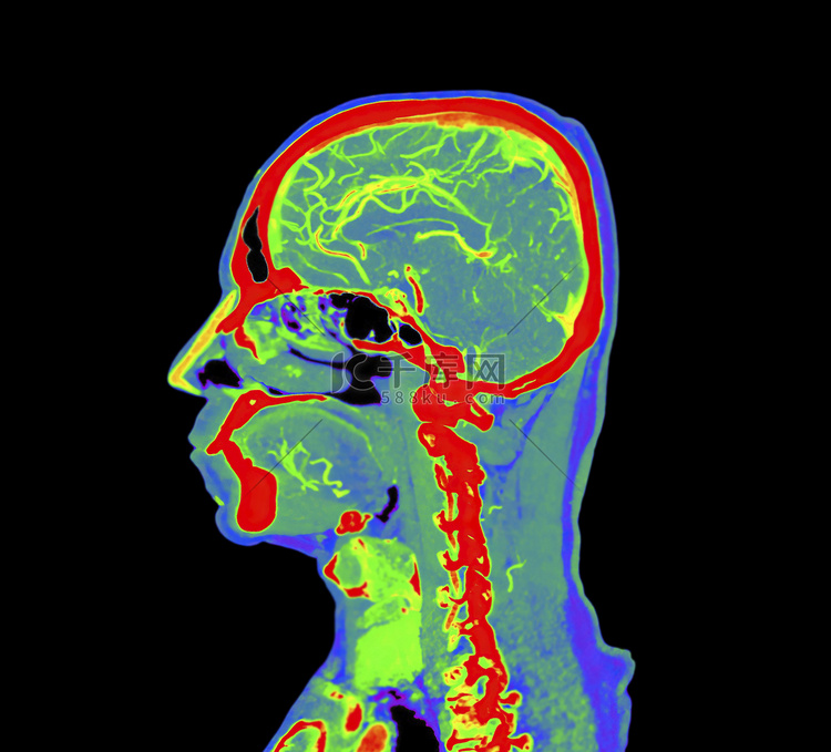 彩色脑 CT 血管造影或 CT