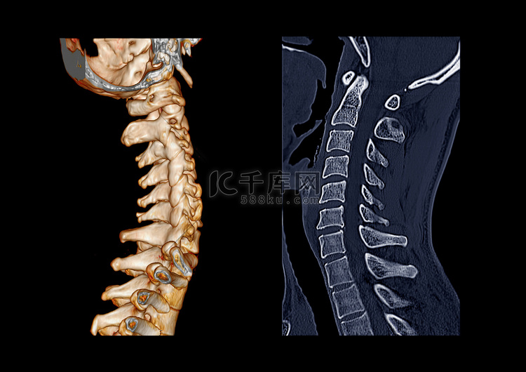 CT C-Spine 或颈椎 