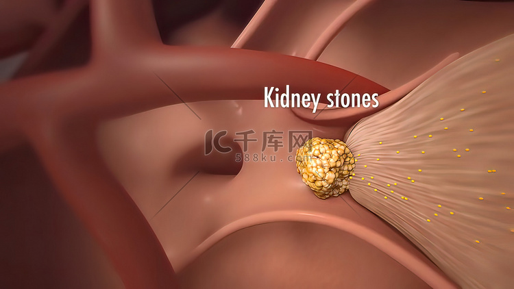 肾结石在人体内的旅程