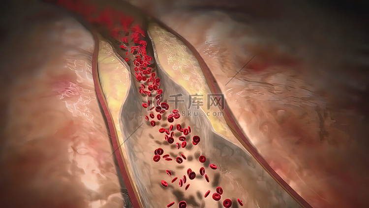 斑块会损伤血管内壁并导致血栓形