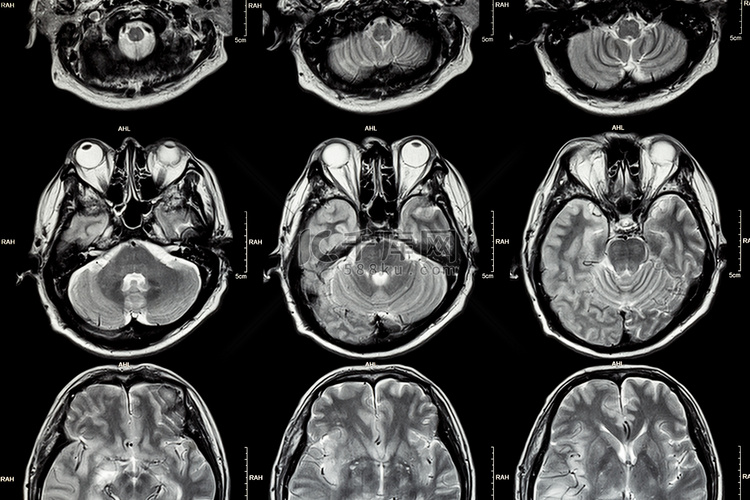 脑部 MRI（脑部横截面）（医