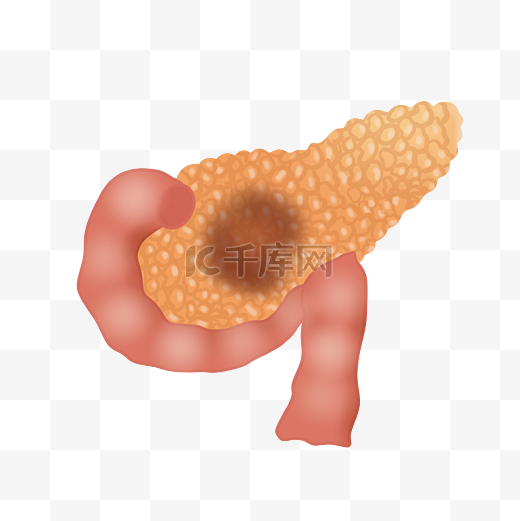 胰腺炎胰腺癌图片