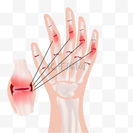 手指关节炎疼痛图片