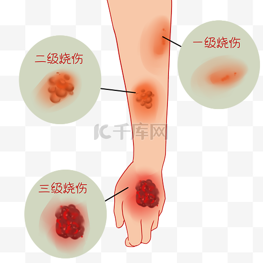 起泡水泡烫伤分级图片