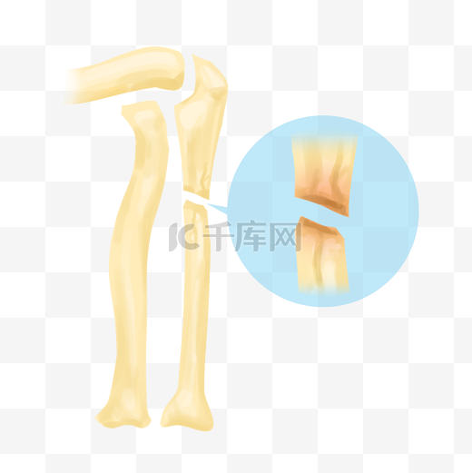 人体骨骼骨折图片