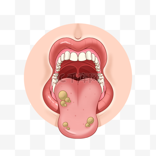 口腔溃疡医学粘膜炎症图片