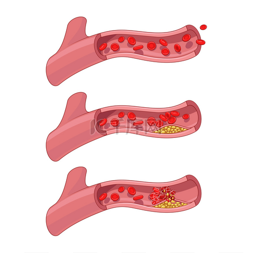 血管和血凝块血栓矢量图图片