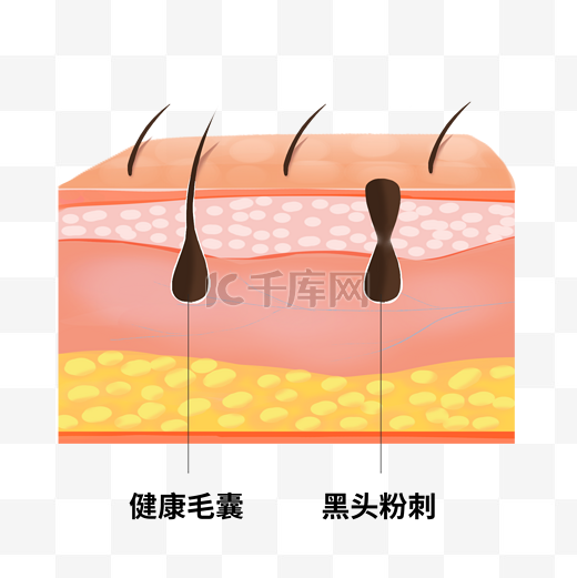 黑头粉刺皮肤问题立体剖面图图片