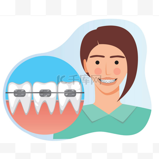一个年轻的女孩带着牙套笑着，这是牙齿矫正、矫正牙齿、调整牙齿、戴牙套和口腔美的概念。用妇女和括号说明平面矢量鱼群.图片