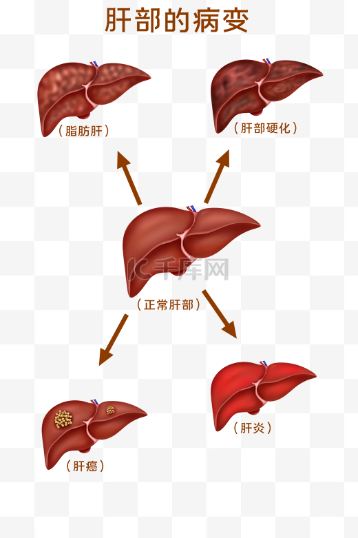 人体医疗组织器官肝病变图片