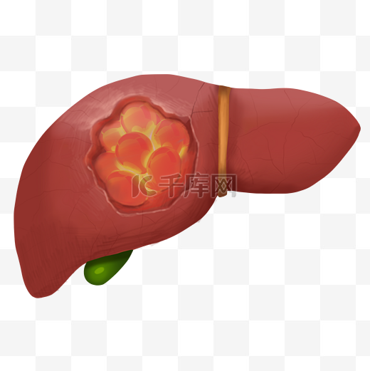 脂肪肝肝硬化人体器官内脏医疗健康图片