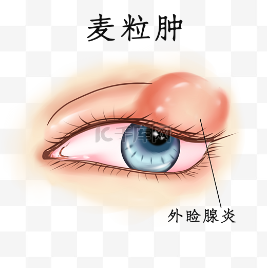 眼睛眼科医疗疾病眼部疾病病变麦粒肿图片
