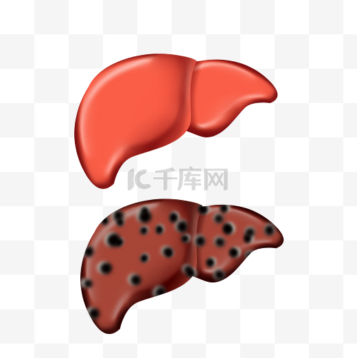 脂肪肝肝硬化肝癌医疗器官肝脏内脏图片