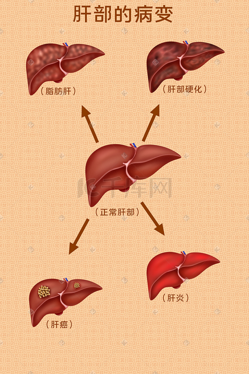 人体医疗组织器官肝病变插画科普科普图片