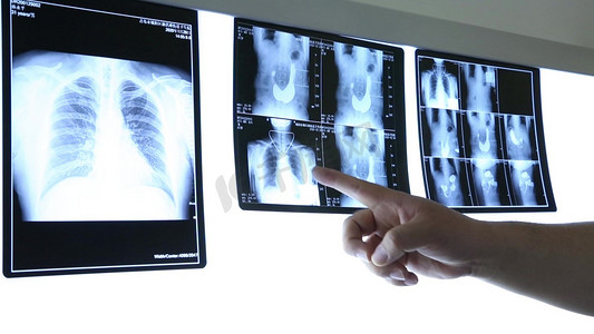 医生检查x光片