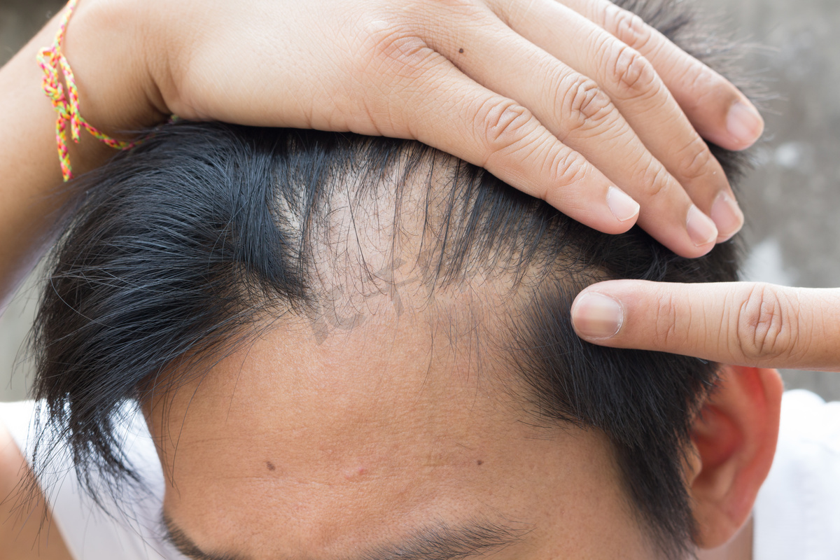 What Does Early Male Pattern Baldness Look Like