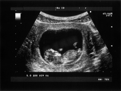 第三个月胎儿的产科超声检查