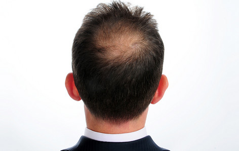 证件照头发头发摄影照片_在人的头发损失