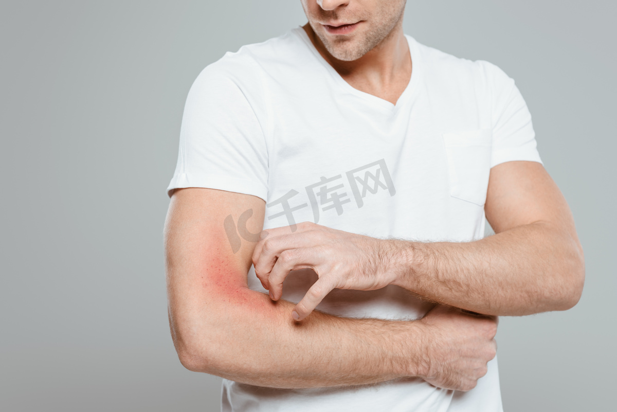 【常見皮膚病】小心猛烈陽光引起敏感，形成「多形性日光疹」。 – Medical Inspire 醫・思維