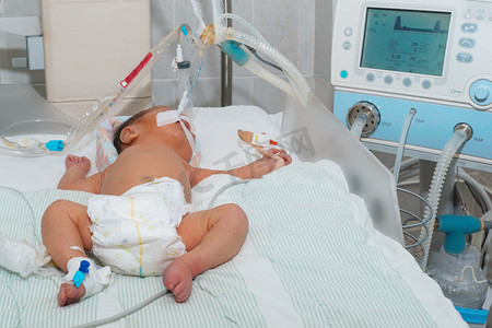 气管插管呼吸机摄影照片_新生儿高胆红素血症对呼吸机或呼吸与脉搏血氧仪传感器和外周静脉留置针在儿童医院