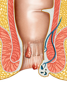炎症背景摄影照片_痔疮