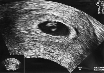 在年龄 6 周 4 天胚胎的超声图像