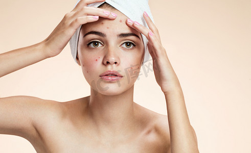 痘痘皮肤护理摄影照片_年轻的女士挤压她的粉刺，去除从她脸上的疙瘩。女人的皮肤护理概念