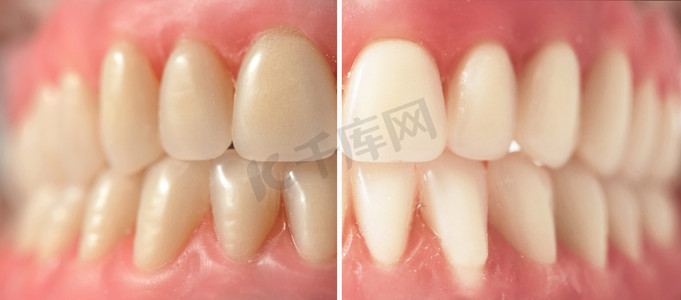 牙齿白化摄影照片_牙齿白化 