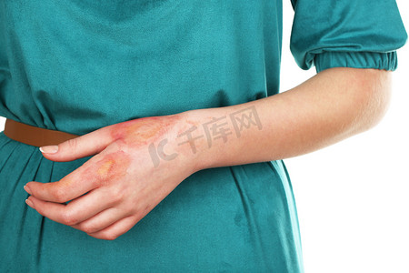 对女性的可怕烧伤手放在白色的背景