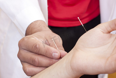 女人接受针灸