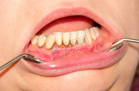 牙垢和牙菌斑