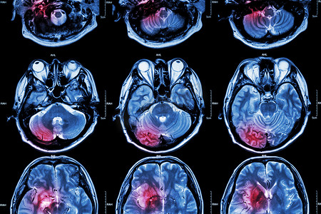 脑医疗摄影照片_脑（脑卒中、脑肿瘤、脑梗死、脑内出血）（医疗、保健、科学背景）（脑交叉部分）的膜MRi（磁共振成像） )