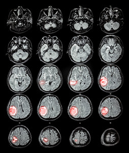 体系认证标摄影照片_磁共振脑: 在右顶叶脑肿瘤