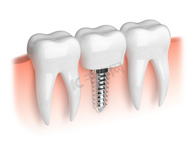 牙齿和牙种植体模型