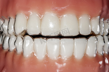 可见摄影照片_看不见和可移动直线对准器牙齿治疗 