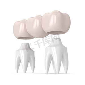 3d 牙科冠牙桥的渲染