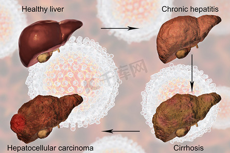 胆囊肿瘤摄影照片_丙型肝炎病毒感染的肝脏疾病进展
