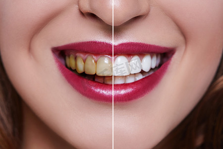 口腔试营业摄影照片_牙科治疗前后的妇女牙齿。牙齿美白。快乐的微笑的女人。牙科健康概念。口腔护理, 牙齿修复。坏牙.
