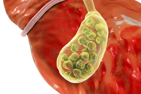肠道菌群小插图摄影照片_胆结石，插图显示底部视图的肝脏和胆囊结石