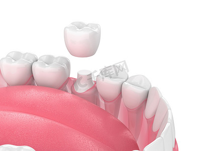 3d. 用牙齿和牙冠修复颌骨的渲染