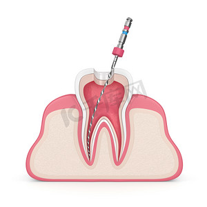 3d. 在牙龈上用根管锉的牙齿呈现在白色背景上。根管治疗概念.