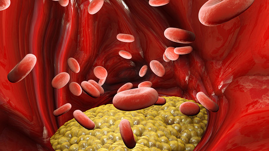 胆固醇形成，脂肪，动脉，静脉，心脏。红血球，血流脂肪形成静脉的收缩，3d渲染