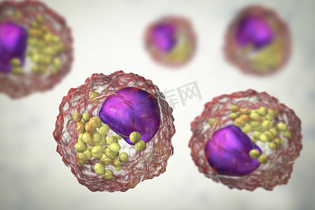 巨噬细胞摄影照片_泡沫细胞,含有脂液滴的巨噬细胞