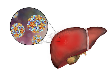 乙型肝炎感染和特写视图的乙型肝炎病毒与肝