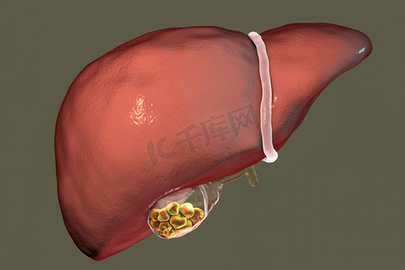防灾减灾插图摄影照片_胆结石，插图显示肝脏和胆囊结石与前面观