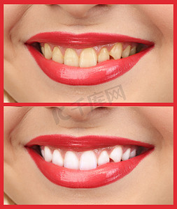 妇女用牙齿微笑： 美白-漂白处理之前, 和之后