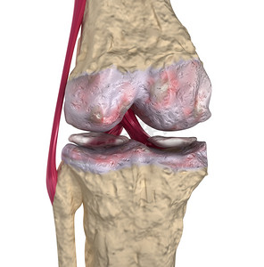 发音部位摄影照片_骨关节炎: 膝关节韧带和软骨