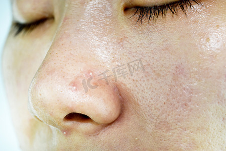 鼻子摄影照片_粉刺性疾病的皮肤病、鼻子上有粉刺的女性近视、疤痕和油腻的面容、美感.