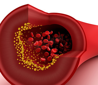 鲜血摄影照片_在血管中的胆固醇斑块的特写视图